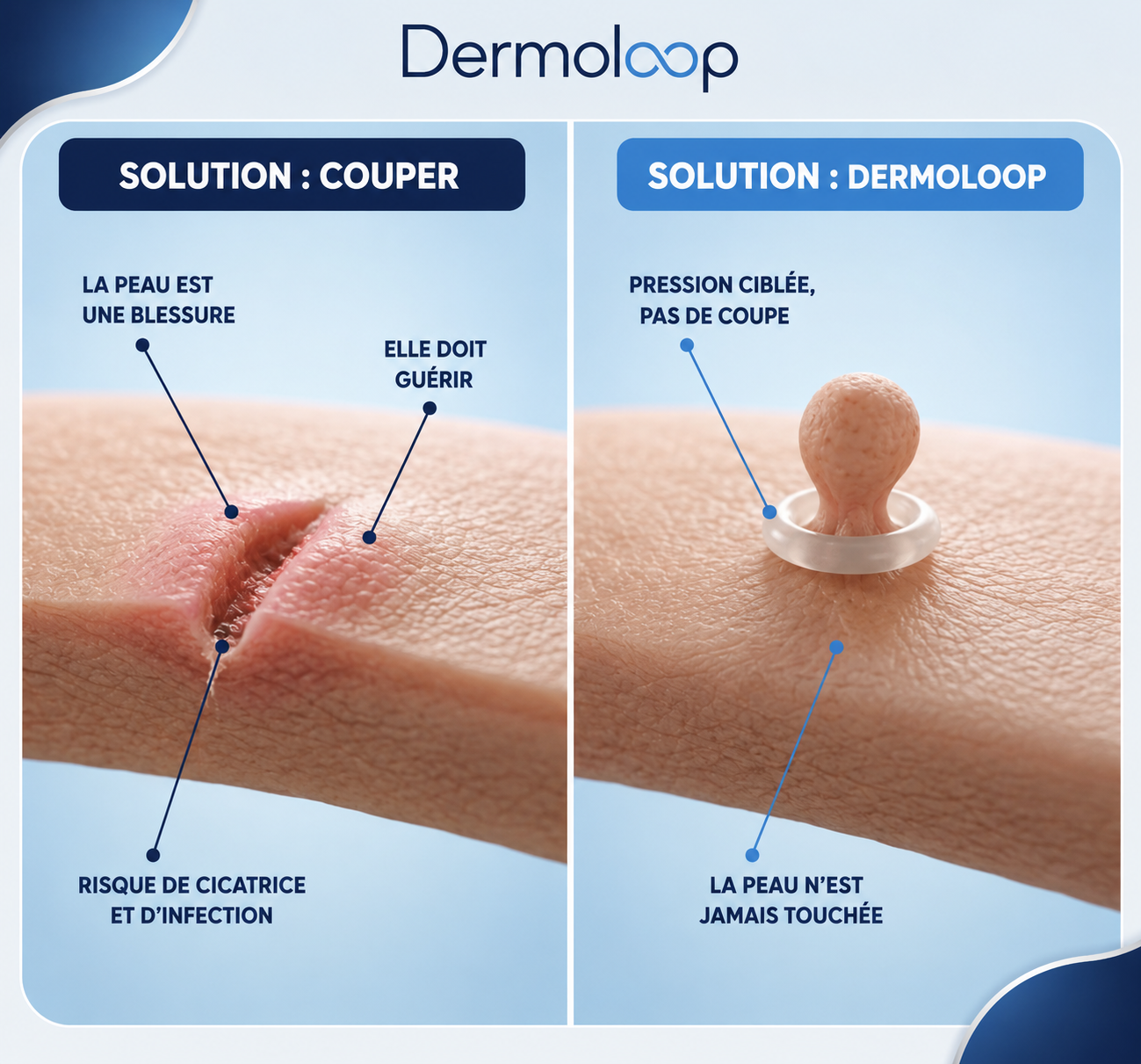 Comparatif : la méthode par incision crée une plaie qui doit cicatriser, alors que DermoLoop applique une pression ciblée sans couper la peau